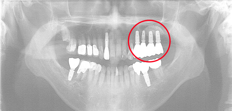 インプラント症例画像2