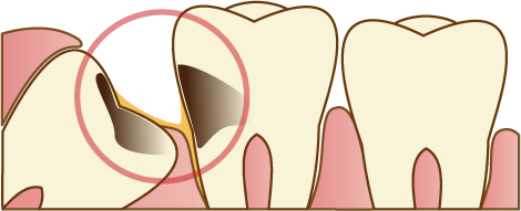 抜歯が必要なケース_2